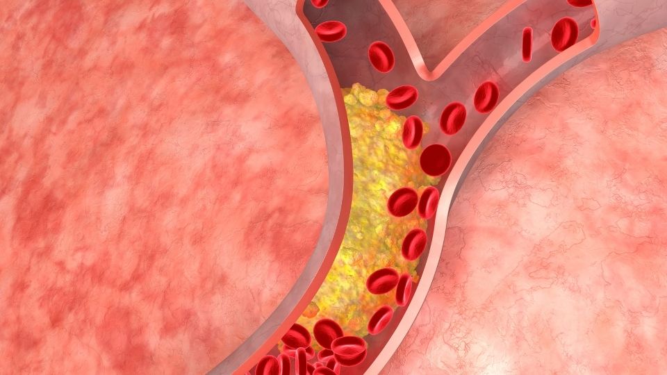 Cholesterol in Artery